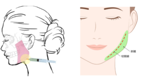 エラボトックス 骨切り 手術イメージ
