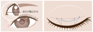 目頭切開 二重埋没法 イメージ